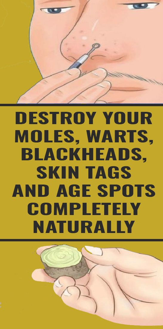 How To Naturally Cure Age Spots, Moles, Skin Tags, Warts, And Blackheads