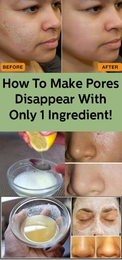 How To Make Pores Disappear With Only 1 Ingredient - 14 skin care Pores beauty secrets ideas